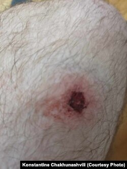 კონსტანტინე ჩახუნაშვილს რეზინის ტყვიის კვალი ხელზე და ფეხზე აღენიშნება.