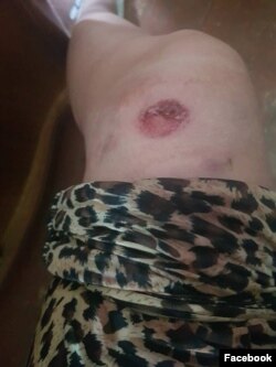 ქრისტინეს დაზიანებული ფეხი