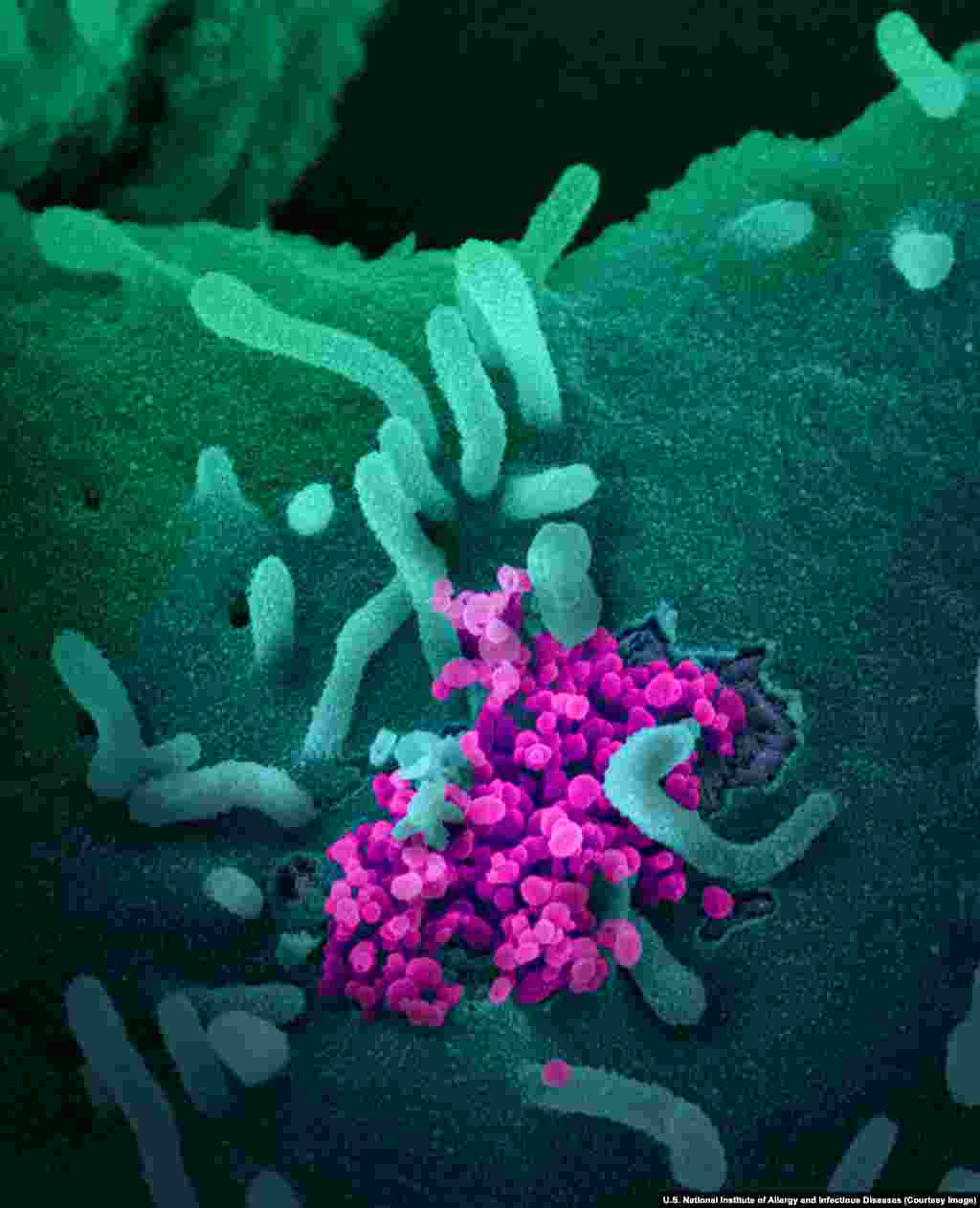 Потрапивши всередину, вірус вивільняє генетичний матеріал, який фактично обманює клітину і продовжує вторгнення в організм. Маса віріонів проривається крізь клітинну стінку і вражає інші клітини. Цей момент зображений тут на прикладі клітини пацієнта, інфікованого COVID-19 у США