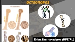 Остеопорозго чалдыккан адамдын көбүнчө жамбаш сөөгү, омурткасы, билеги жабыркайт.
